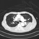 Rib fracture, lung contusion, hematoma, pneumothorax, hydropneumothorax: CT - Computed tomography